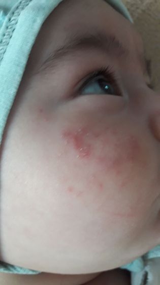 А-DERMA