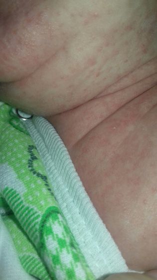 SOS! Аллергия?шелушения кожи?