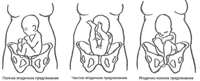 Моё кесарево сечение