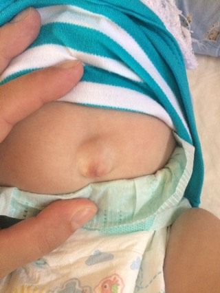 Переживаю. Грыжа?
