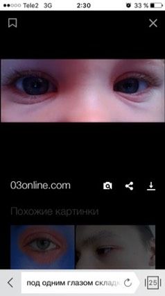 Разные складки под глазами у ребёнка