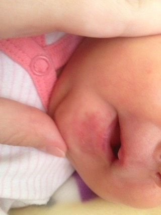 Прыщики под нижней губой ?