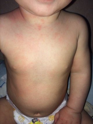 Что за сыпь?кто поможет разобраться?педиатр не поняла