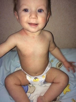 Что за сыпь?кто поможет разобраться?педиатр не поняла