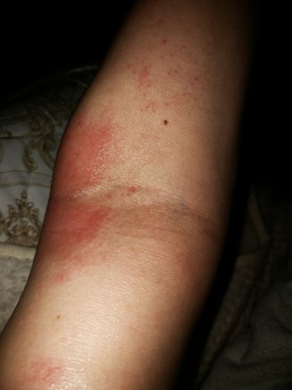 Сыпь и зуд на руках
