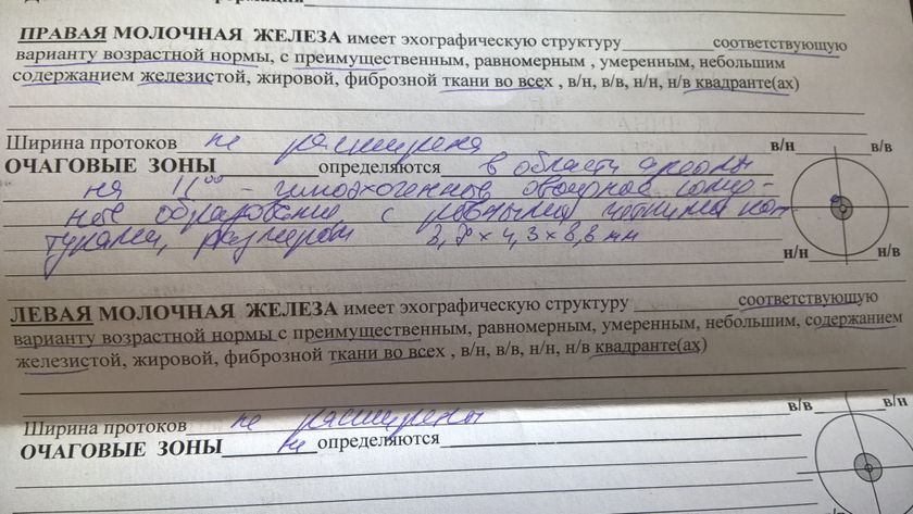 SOS. Фиброаденома молочной железы. Кто знаком С таким диагнозом?