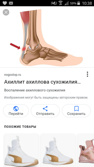 Ахиллит (воспаление ахиллова сухожилия)