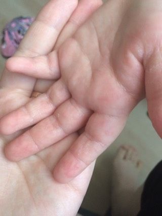 Сыпь на ладошках
