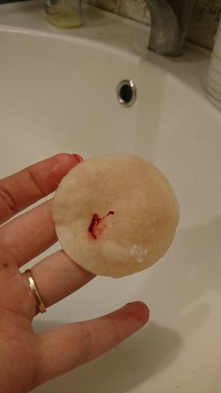 Что это может быть? Кровь в моче со сгустками?