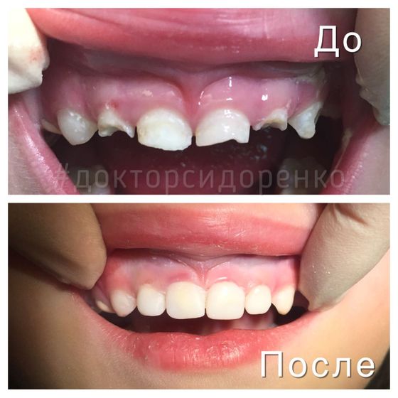 Долечила зубы ребенку