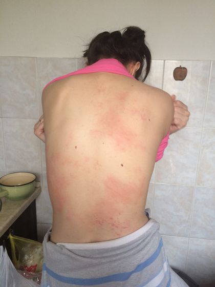 Сильный зуд и сыпь (похожа на крапивницу по фоткам инете)