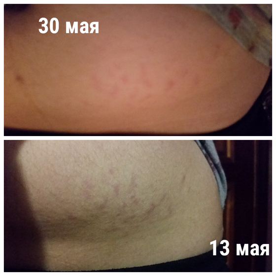 Моя борьба с растяжками)