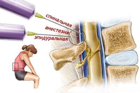 Анестезия