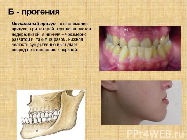 мезиальный прикус у малышей.
