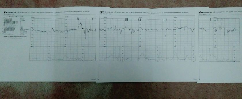 2ое КТГ в 34.6 недель 👶📈📉