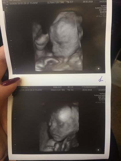 Узи 24,4 недели, двойняшки👶🏻👶🏻❤️