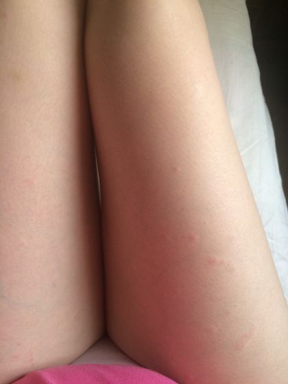 Сильный зуд и сыпь (похожа на крапивницу по фоткам инете)