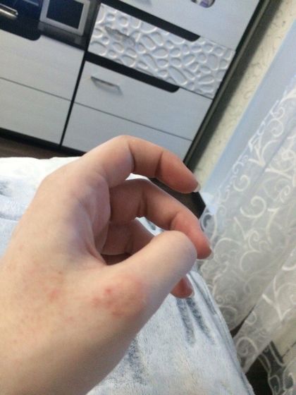 Аллергия?