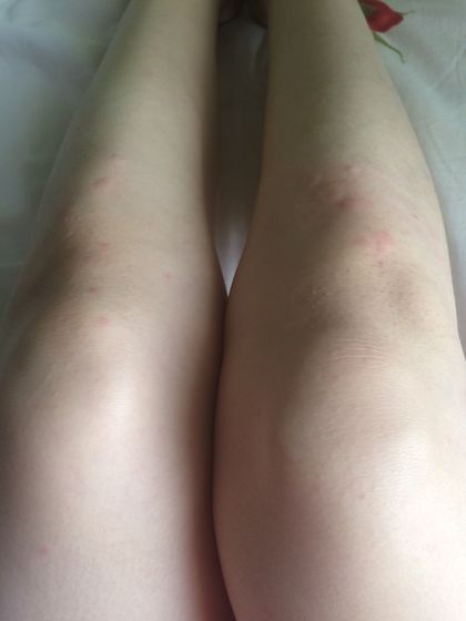 Сильный зуд и сыпь (похожа на крапивницу по фоткам инете)