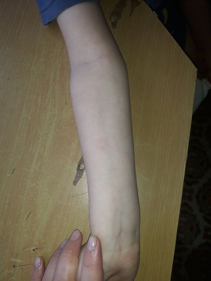 Вчера сделали диаскин тест