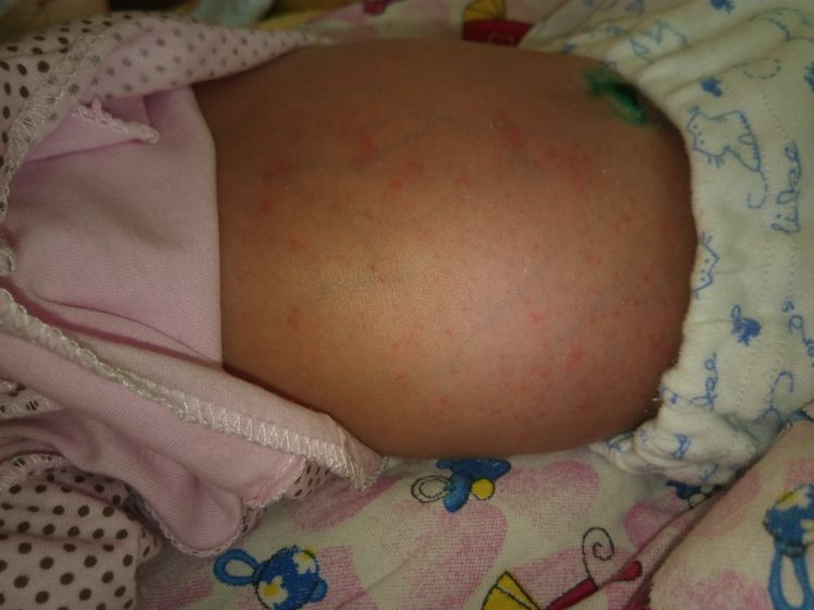 Сыпь