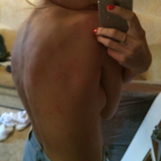 Крапивница, которую помогли вылечить лишь врачи гомеопаты!