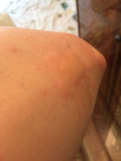 Сильный зуд и сыпь (похожа на крапивницу по фоткам инете)