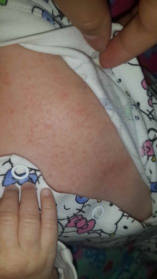 Не пойму аллергия или потница