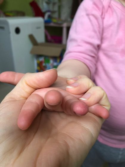 SOS! У кого у деток кожа на пальцах облезала и краснела?+фото