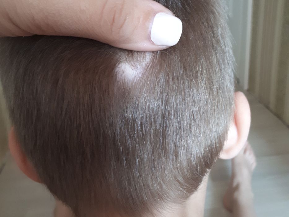 Выпадение волос у ребенка (фото)